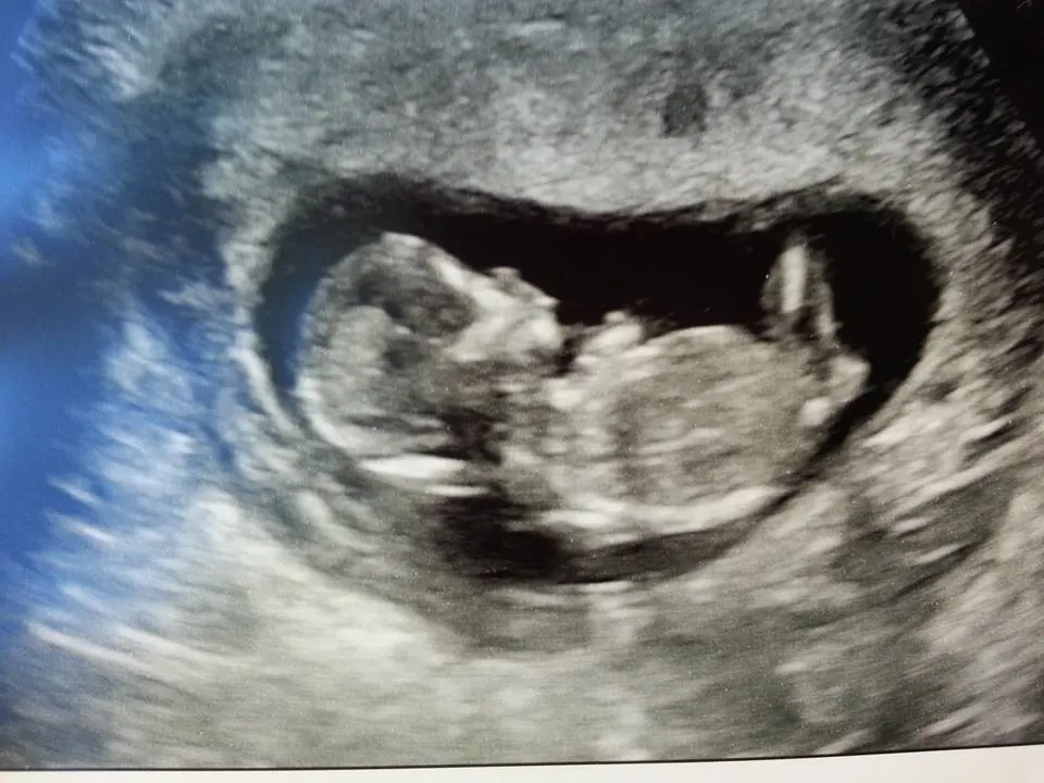 Denver Housewife Ultrasound Pic